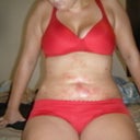 2 days post-op