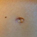 Notice the left side is lighter in color and the skin is wrinkly. From steroid injection.