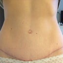 Scar at 13 weeks PO.
