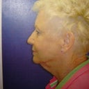 Before picture- visual turkey neck