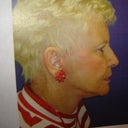 After Picture- Look revitalized and younger