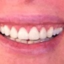 This is a photo of the veneer redo temporaries. They are smaller and match my other teeth much better than the first veneers.