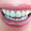 After redo crown lengthening with sutures. My gums now feel much less tender, the swelling has subsided and the bleeding has  almost stopped.
