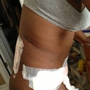 Post op day 1