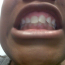 Before Braces