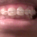 After Braces, they have only been on one month and I already see improvement
