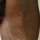 One month post op and there is still a lot of bruising from my arm lipo.
