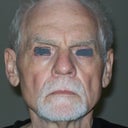 The day before surgery. Note hollow, sagging cheeks, prominent jowls, slack jawline and neck.