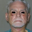 Fourth day after surgery. Note tighter jawline and neck, no jowls, lesser cheek hollows, less prominent lasonabial folds.