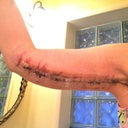 3 days post-op