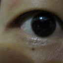 how my it looks like before surgery (right eye)