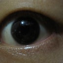 how my it looks like before surgery (left eye)
