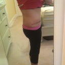 3 Months Post Op- Left Side View of Incision
