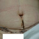9 days post op