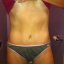 Exactly 1 year post op!