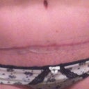 Wk 18 Scar with steristrips