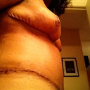 one week post-op