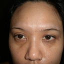 2nd Day - A little Bruised on Right Eye, also from needle mark