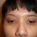 5 Days after, still a little bruised on right eye, most obvious is the needle mark.
