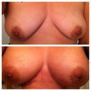 Before and 2nd day post op