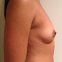 Right boob