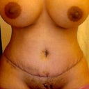 4 days post op, I just took off the tape to show scar. I am happy with it.