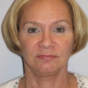 Mini Facelift With Fat Transfers