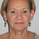 Mini Facelift With Fat Transfers
