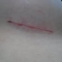 Right Incision 6 weeks