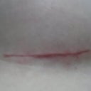 Left Incision 6 weeks