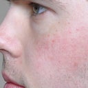 After almost 4 weeks, the flushing is gone but there is still some background redness. I'll be scheduling another treatment soon.