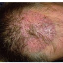 Immediate after the 1st op in May 2007...ouch