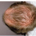 I used grow it long and sweep it forward. This is pre-op in may 2007
