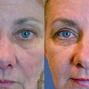 Eyelid Surgery