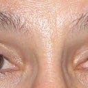 My eyes are very hollow due too much fat removed.