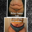 Here is the Before and 5 weeks after Tummy Tuck!! I see a HUGE difference so far!!
