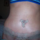 Post op day 10!