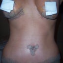 Post op day 10