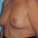 Explant (Removal Of Breast Implants) With Breast Lift