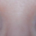 update, after 7 months, no makeup, no visible scars