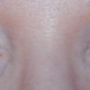 Update, after 7 months, no makeup, no visible scars