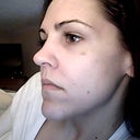 One day after. Very minimal bruising in nasolabial fold and under eye.
