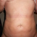 Two weeks post surgery