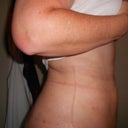 Two weeks post surgery