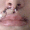 Day after surgery
