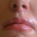 2 days after surgery