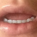 24 hours after surgery