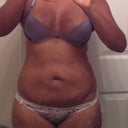 I week post op... I was super swollen! I couldn't even bend to put on my shoes