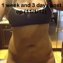 Still very swollen switching from the small to the extra small compression