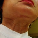 After the second surgery.  Still a "turkey neck".